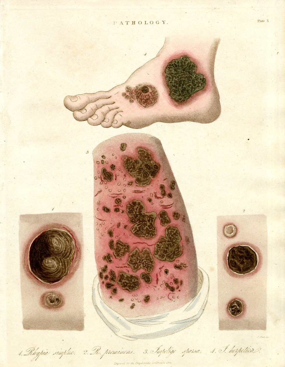 Condizioni cutanee patologiche - Pityria; Impetigine e Sifilide da John Pass