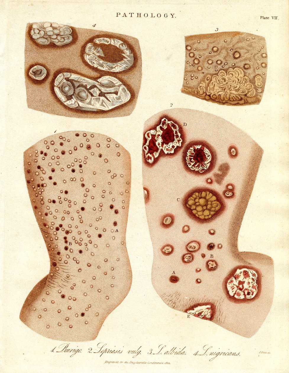Condizioni patologiche della pelle: Schurigie; Pelle lebbrosa; Pallade e Impetigine da John Pass
