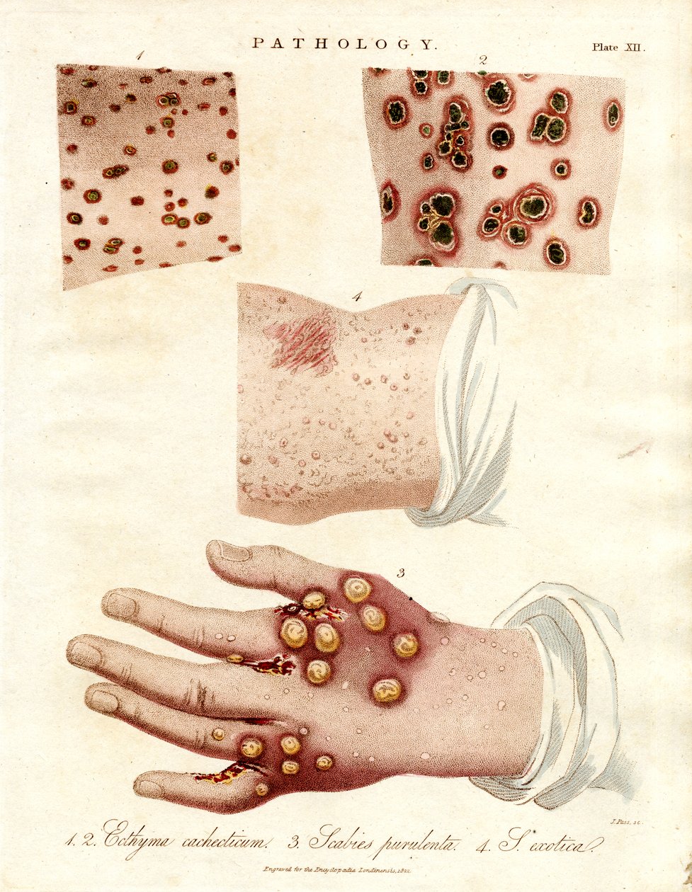 Malattie della pelle: Ecthyma; scabbia purulenta e vaiolo da John Pass