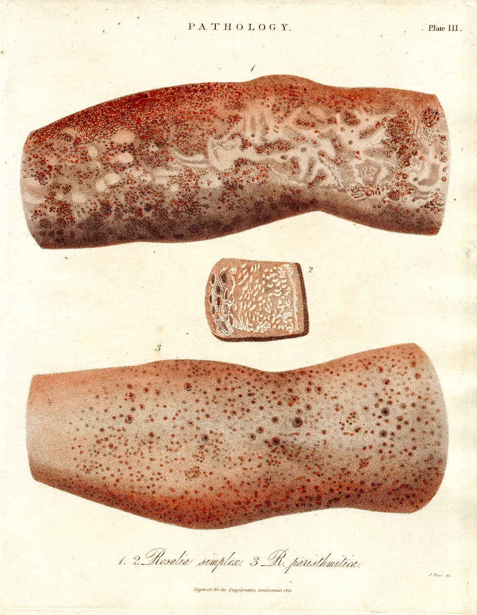 Eruzioni cutanee - Roseola simplex e Roseola paristhmitica da John Pass