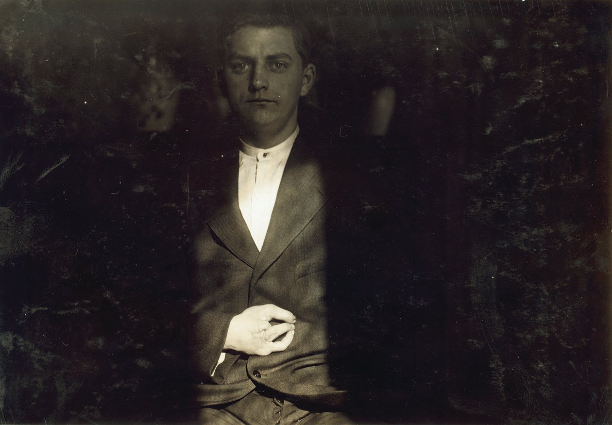 Frank Wiegel di Brooklyn, ferito dopo aver lavorato 18 ore al giorno a 15 anni, gli sono state amputate due dita della mano destra, New York City da Lewis Wickes Hine