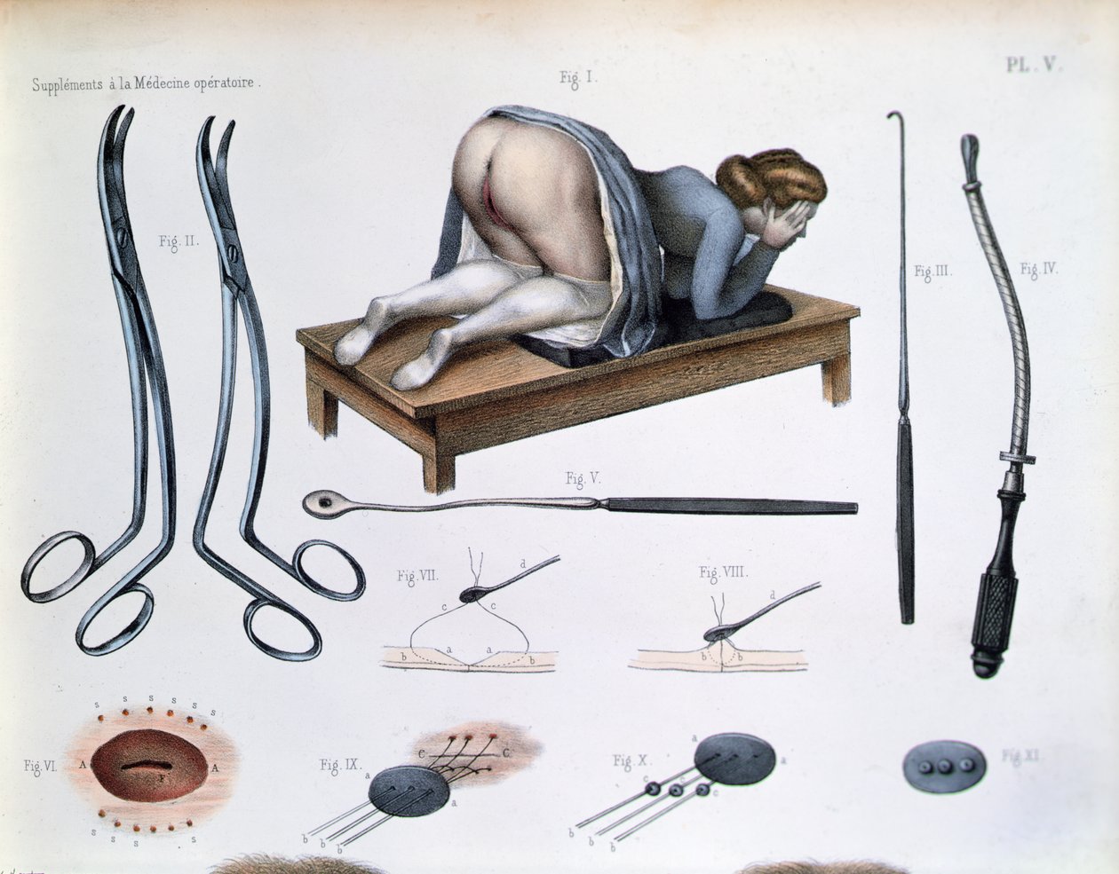 Operazione su una fistola vescico-vaginale, da 