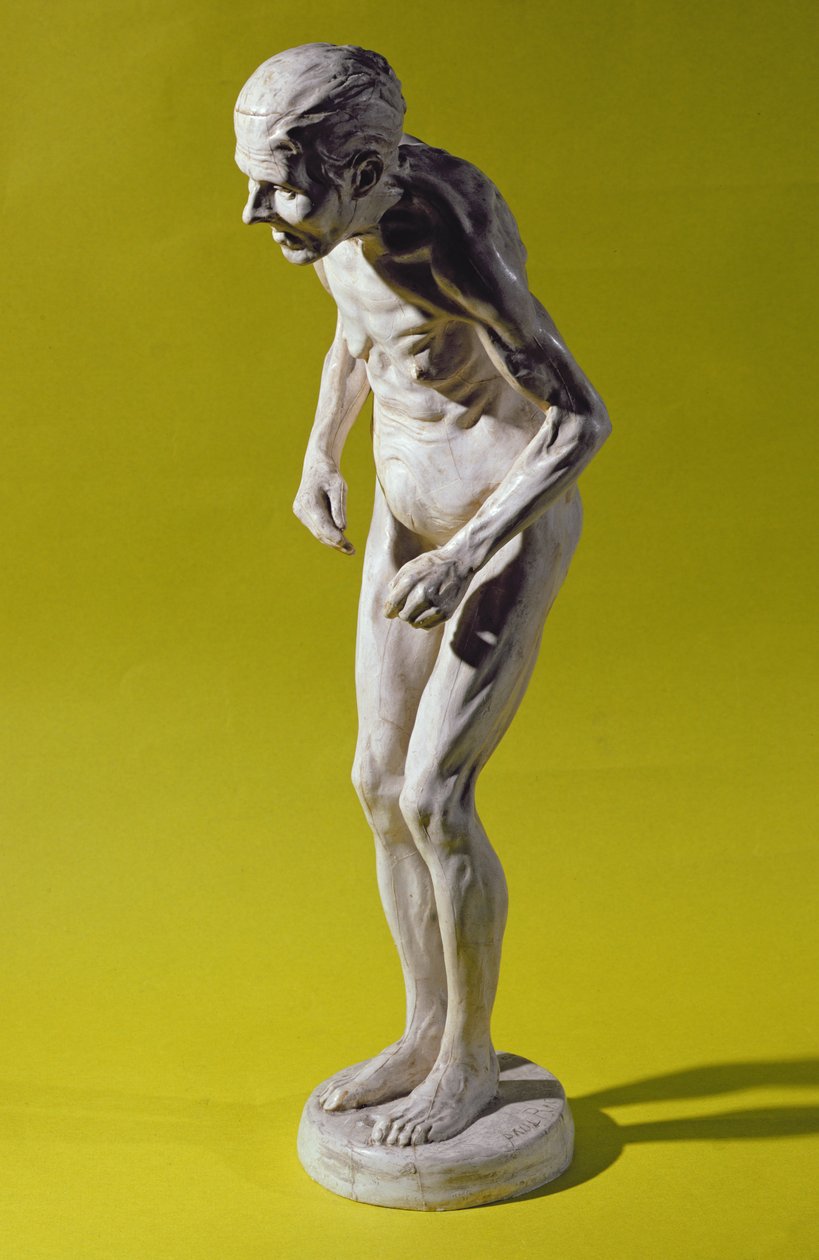 Figura di donna con malattia di Parkinson da Paul Marie Louis Pierre Richer