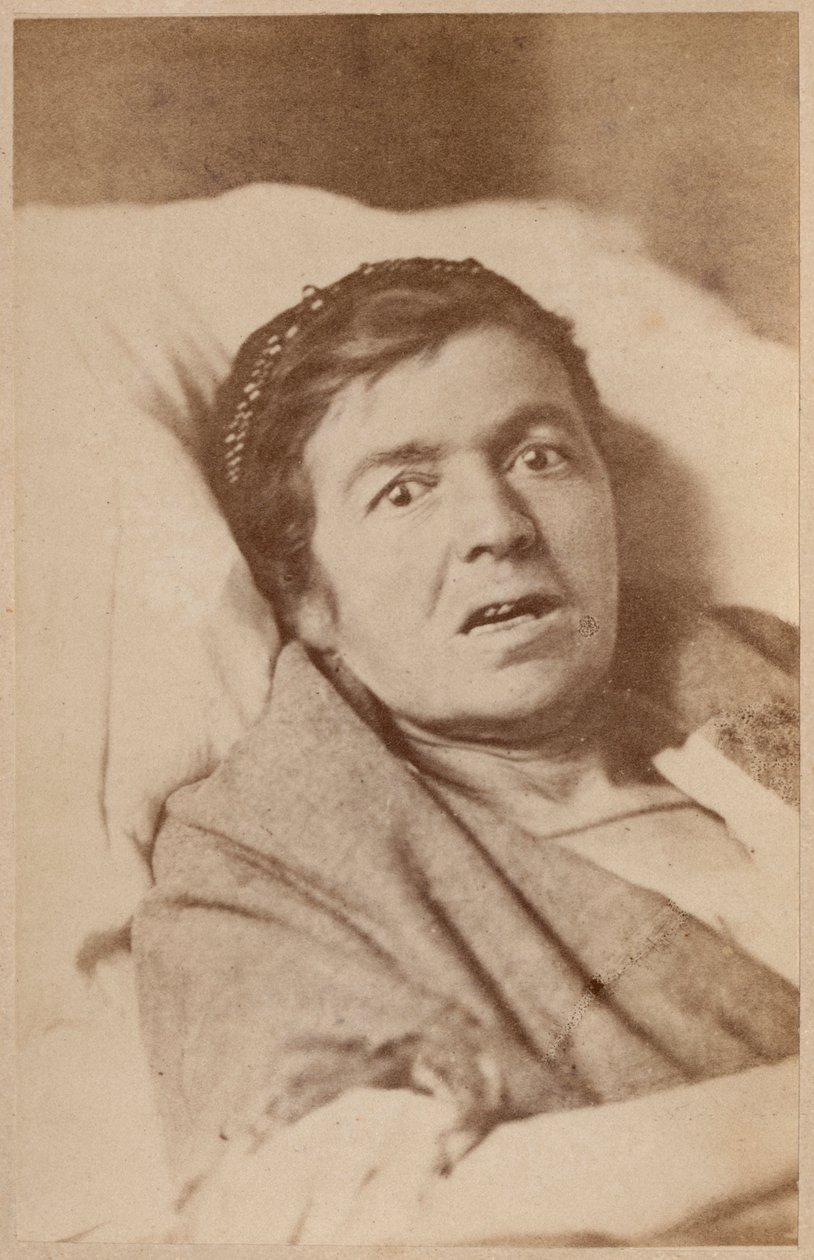 Epilepsia isterica, contrazione del viso, tavola VIII da 