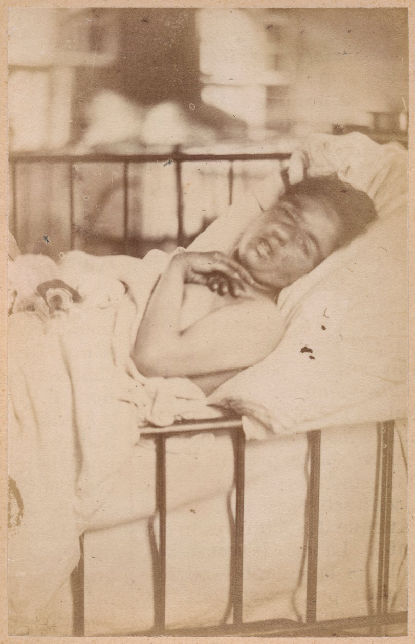 Epilepsia isterica, contrazione permanente, tavola XXVIII da 