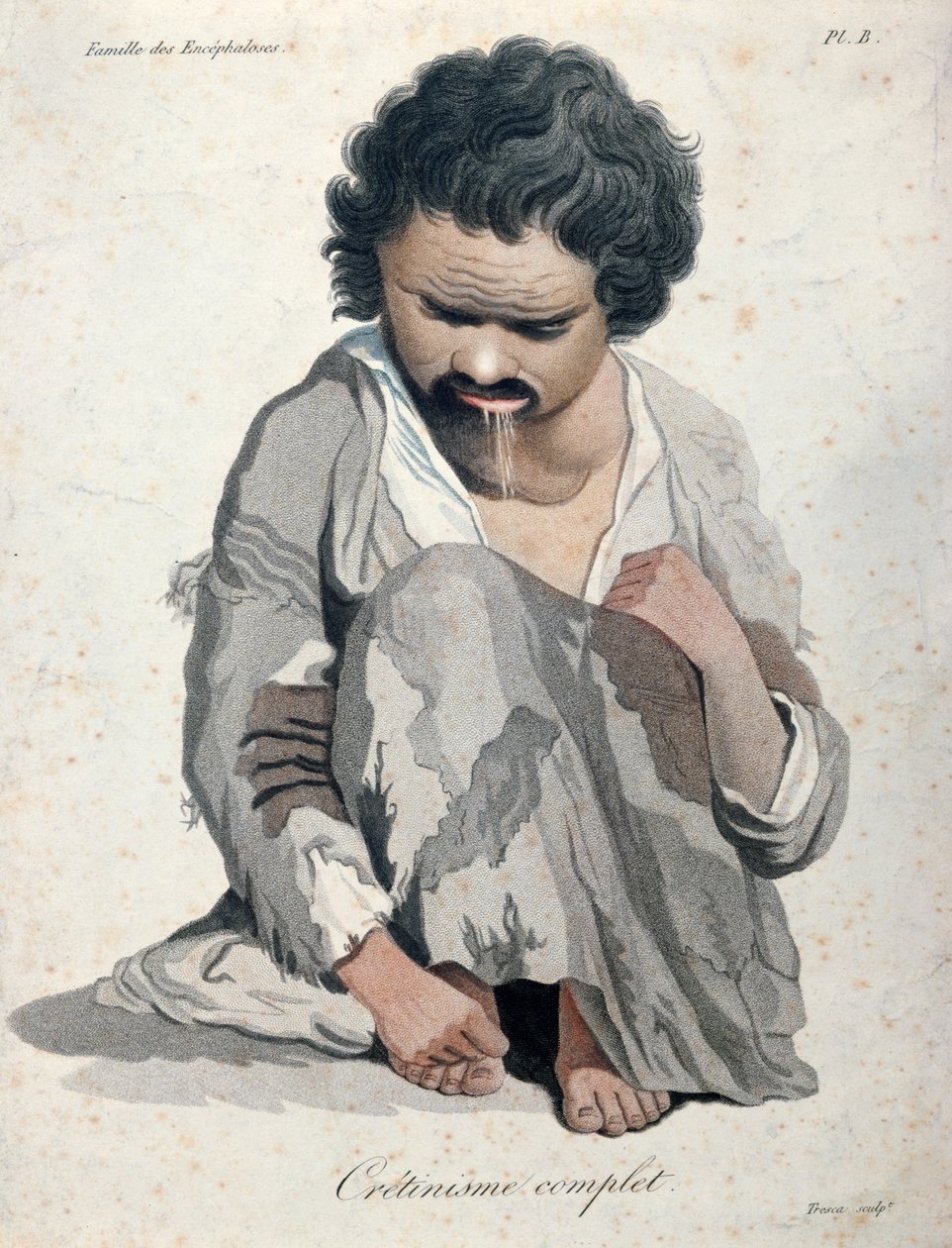 Cretinismo totale, da un libro di Baron Jean Louis Alibert (1768-1837) da Salvadore Tresca
