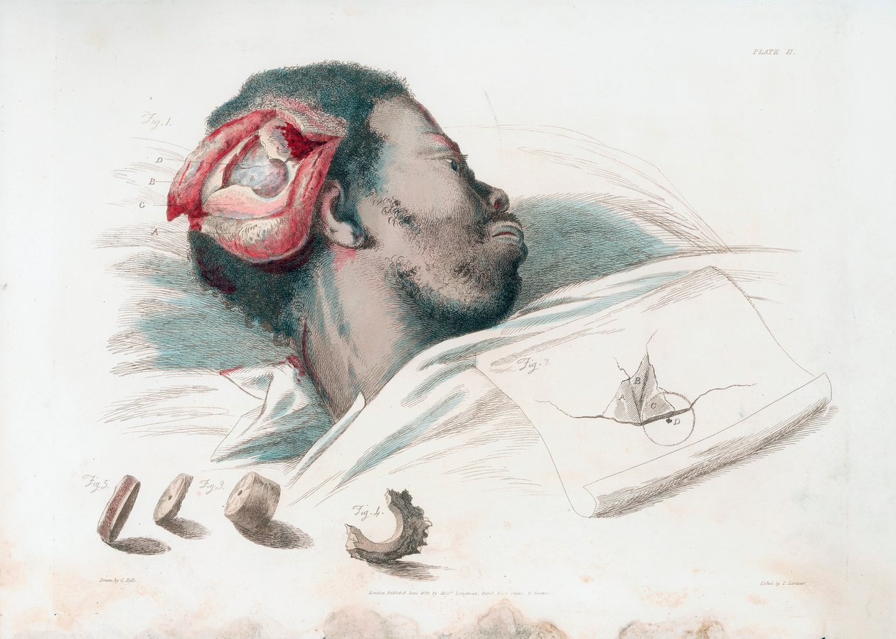 Vista della ferita nel cranio dopo trapanazione e rimozione del pezzo di osso frantumato in basso a sinistra, 1821 da Thomas Landseer