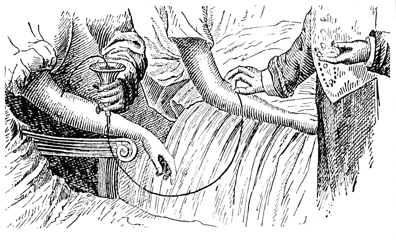 Trasfusione di sangue, c1880 da Unbekannt