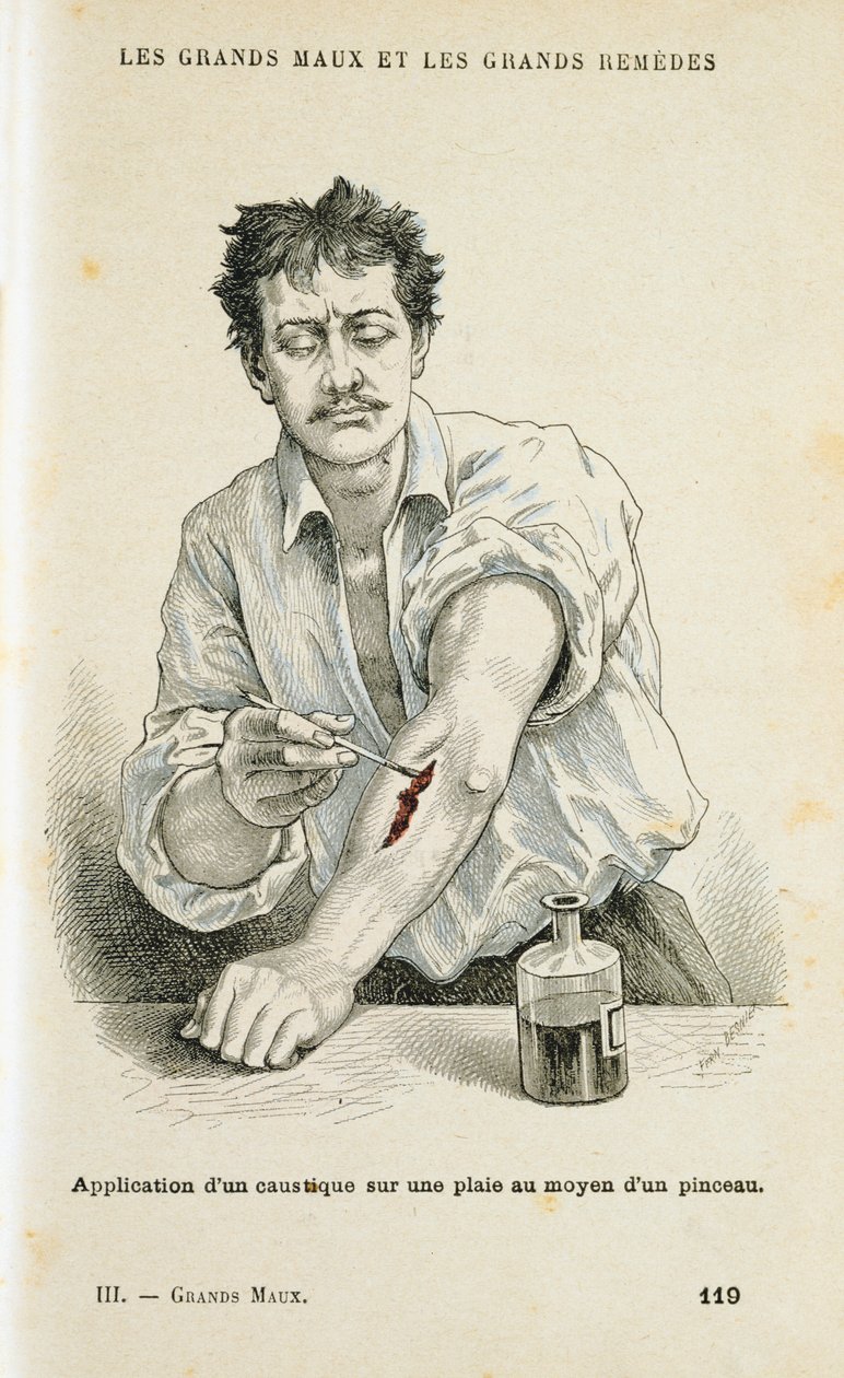 Disinfettare una ferita con una soluzione antisettica, c1890 da Unbekannt