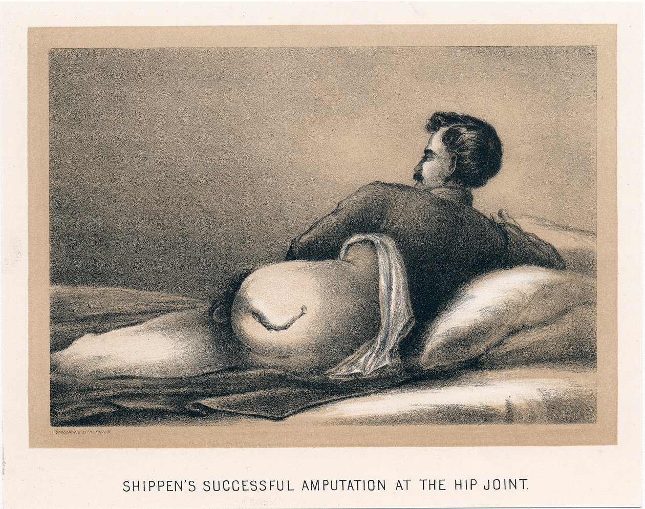 Amputazione riuscita di Shippen all