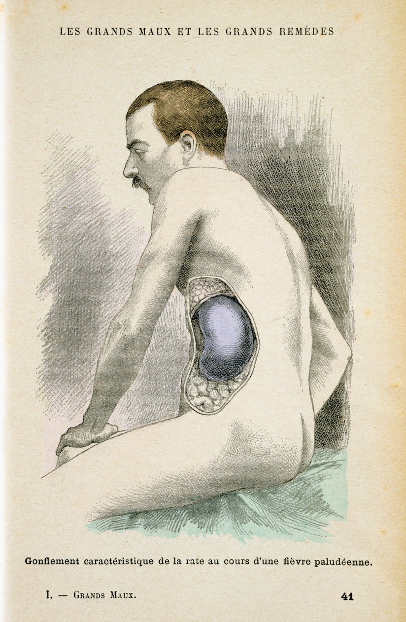 Milza ingrandita tipica di un paziente con malaria, c1890 da Unbekannt