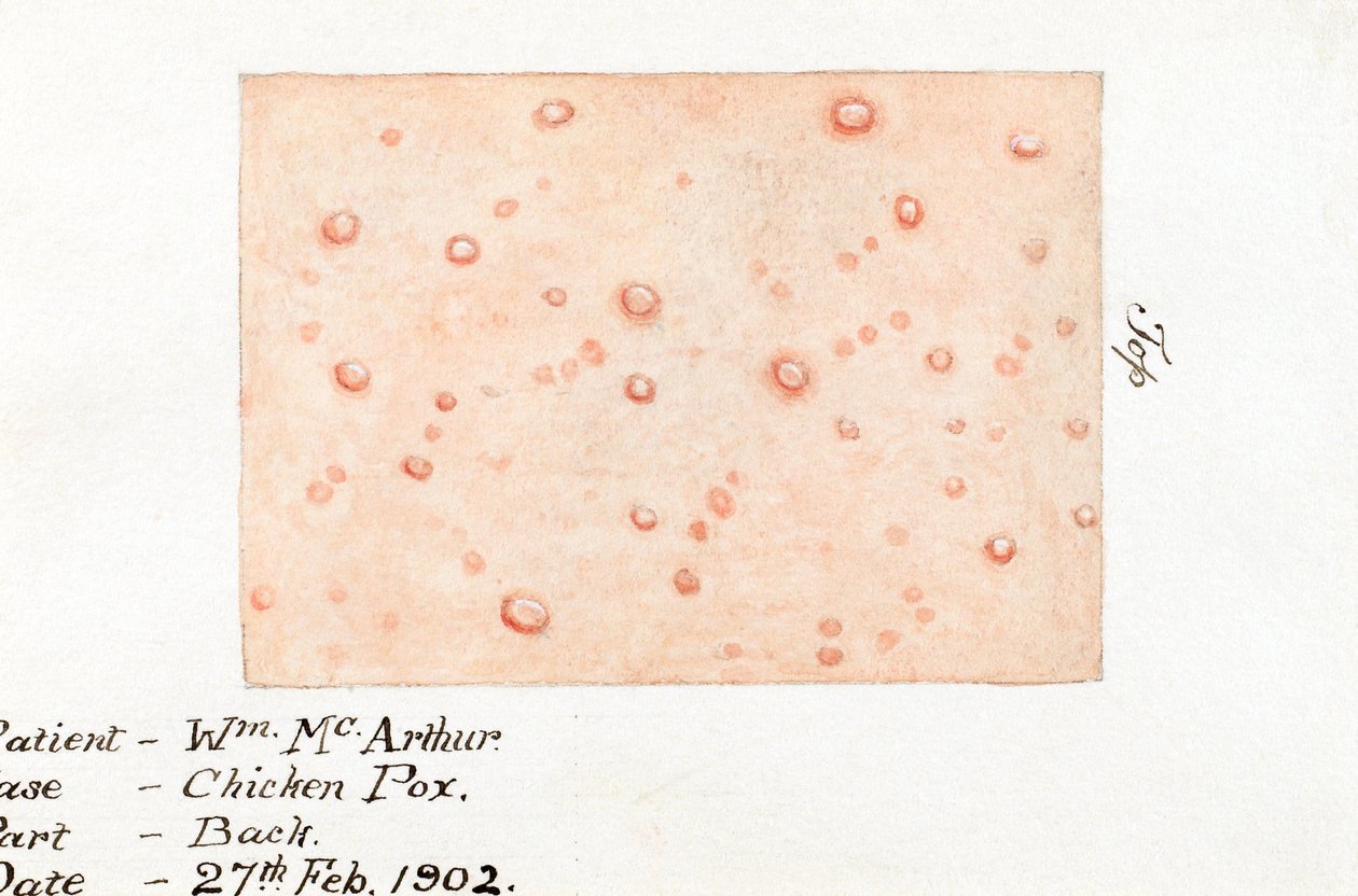 Malattie, Varicella Acquerello della malattia della pelle varicella, 27 febbraio 1902 da Unbekannt
