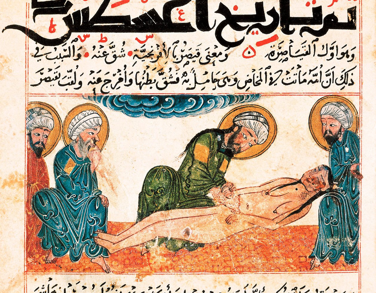 Rappresentazione di un parto cesareo. Miniatura tratta da un manoscritto di medicina di Abu Raihan Al-Biruni (o Alberuni) (973-1048), intellettuale e scienziato persiano, folio 161. da Unbekannt