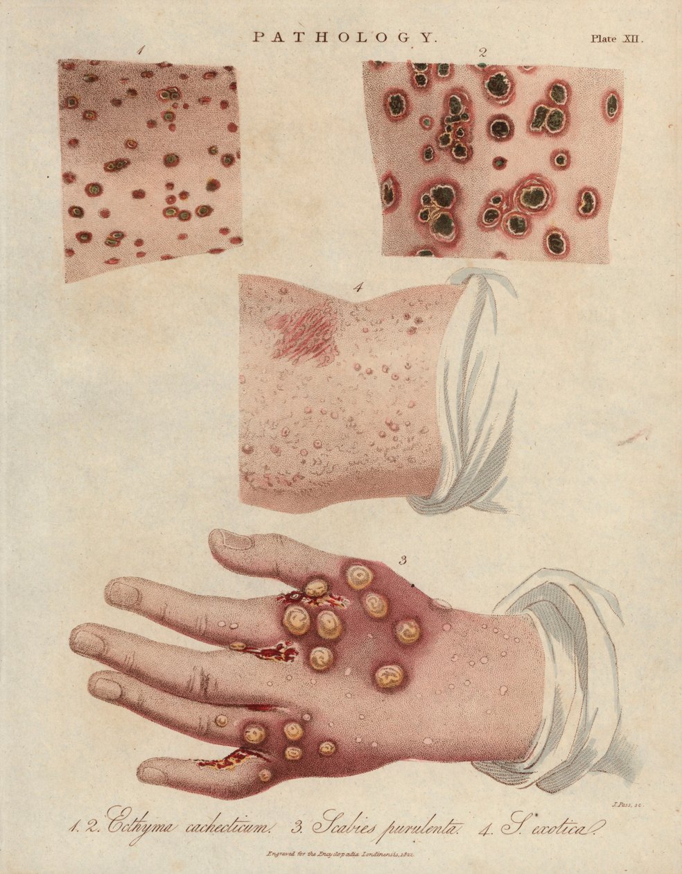 Ulcera cutanea, scabbia purulenta e scabbia causata da un acaro sarcoptico della scabbia - Litografia di John Pass, pubblicata in 