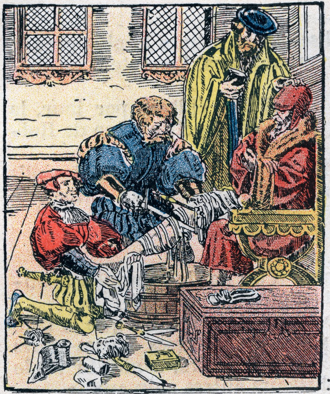 Amputazione di una gamba nel XVI secolo. da Unknown artist