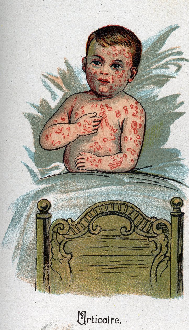 Malattie infantili: Orticaria. In “La nuova medicina naturale” di F.E. Bilz da Unknown artist