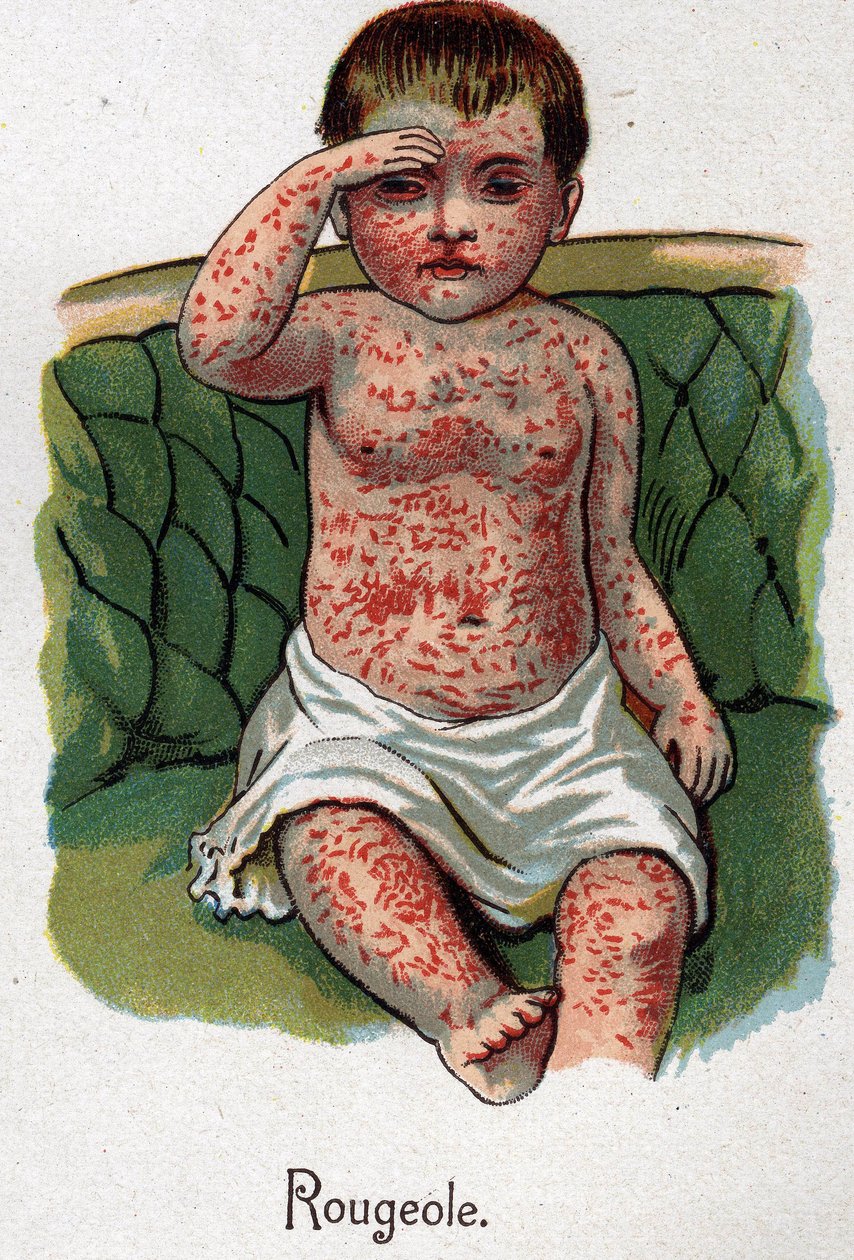 Malattie infantili: Morbillo. In 