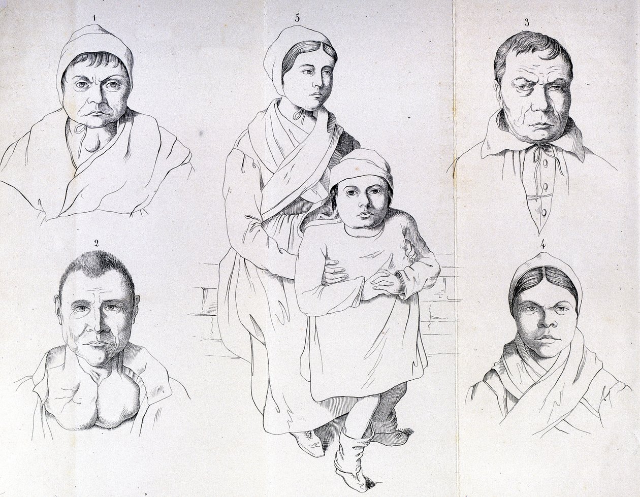 Considerazioni sulle cause del cretinismo endemico di Morel da Unknown artist