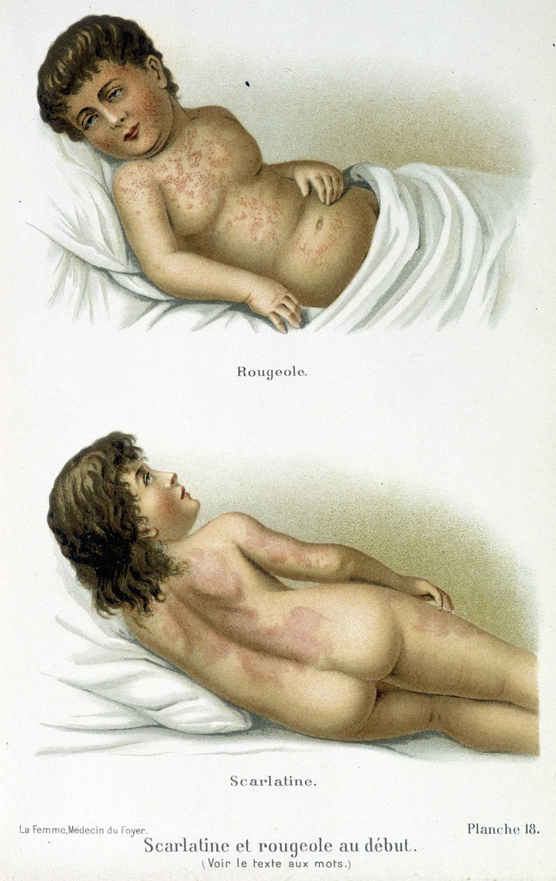 Scarlattina e morbillo - XIX secolo da Unknown artist