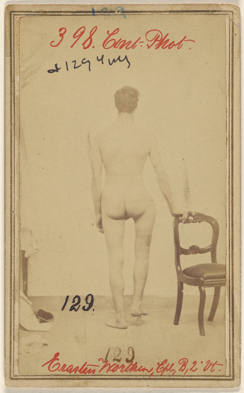 Frattura del terzo superiore del femore. Erastus Worthen, Corpo Co. B. 2nd Vermont Vols. 25 anni - Residenza Stockbridge VT. da Unknown artist