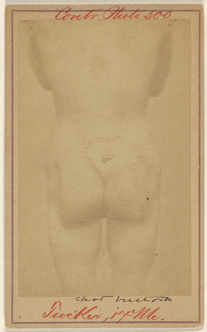 [Jno. E. Tucker, colpito da una pallottola nelle natiche, vittima della guerra civile]. da Unknown artist