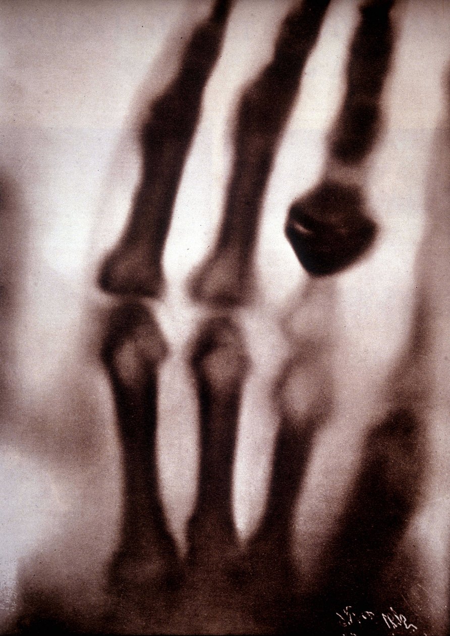 Raggi Roentgen o raggi X Prima fotografia: la mano della moglie di Roentgen. 22/12/1895. da Unknown artist
