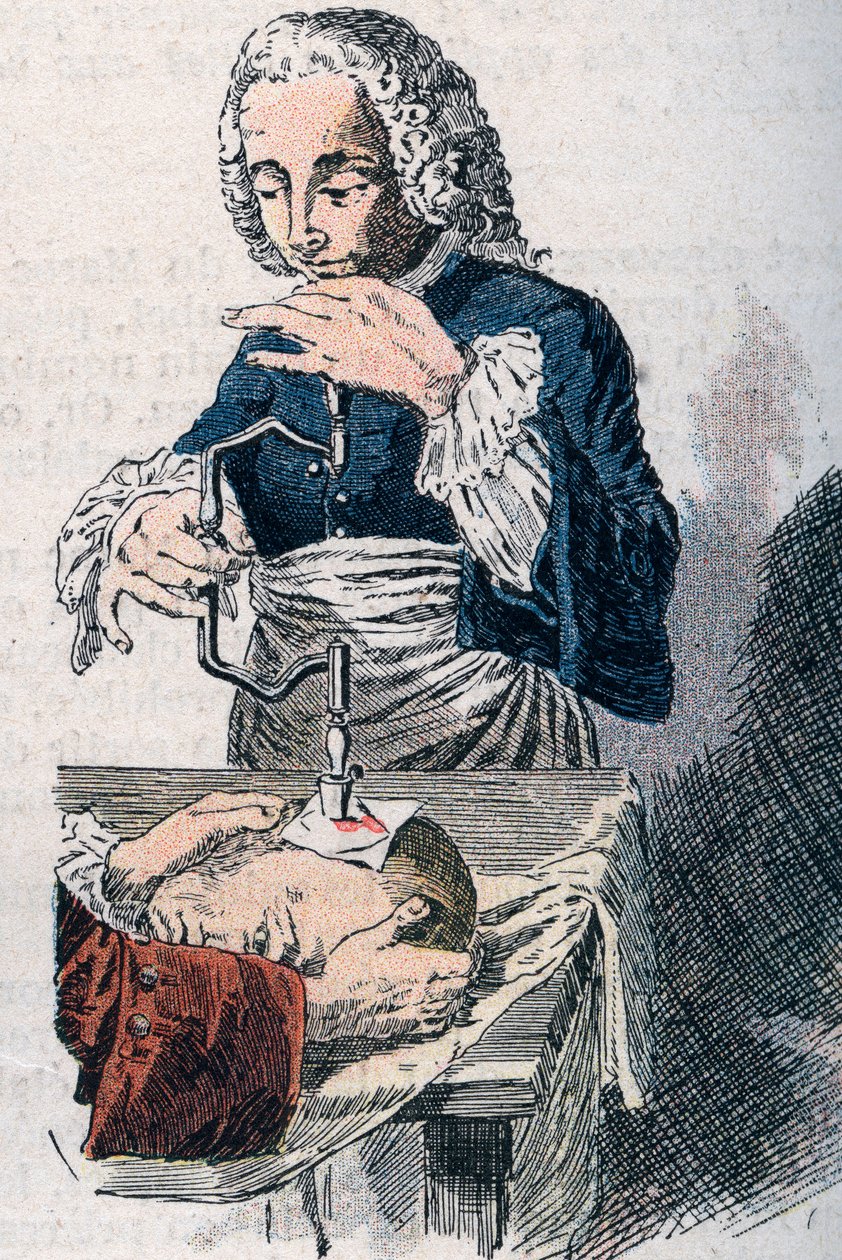 La trapanazione. Stampa del XVIII secolo da Unknown artist