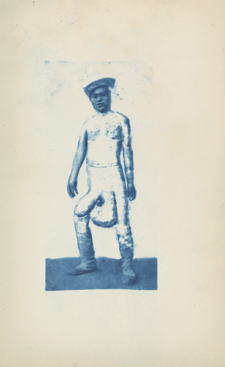 Elefantiasi, c. 1870 (foto) da Unknown photographer