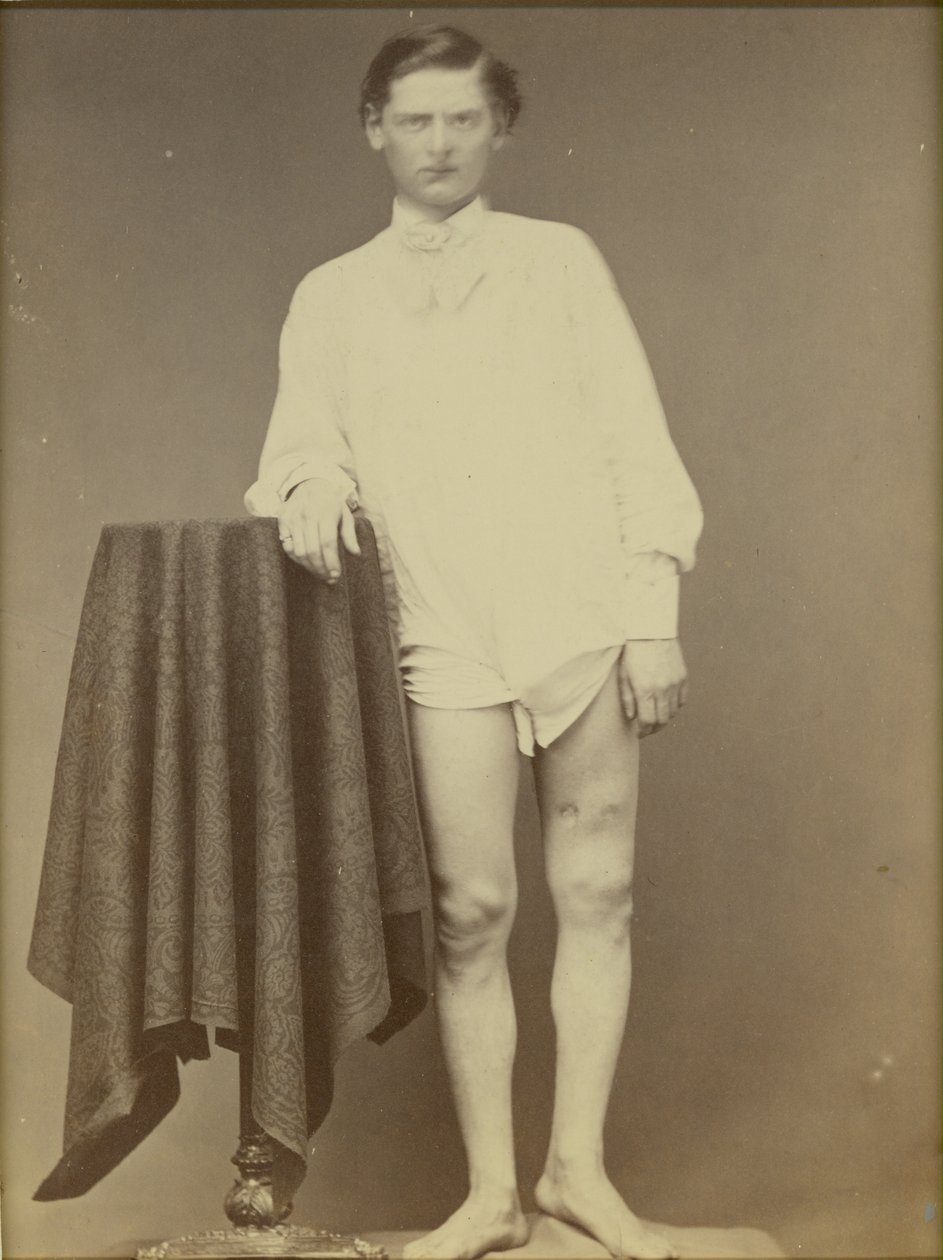Soldato ferito della guerra civile (Privato Charles Westerfield, Esemplare n. 4278 del Museo Medico dell