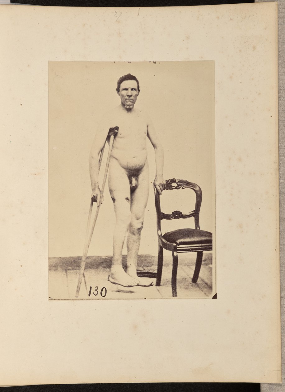 Frattura consolidata da arma da fuoco del terzo medio del femore destro da William H. Bell