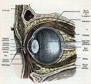 Sezione verticale di un bulbo oculare con cataratta. Incisione da 