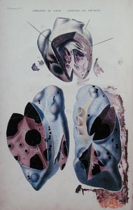 Apoplessia del cuore e dei polmoni, tavola illustrativa da 