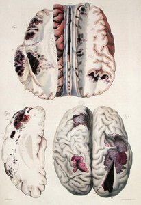 Apoplessia capillare, da 