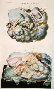 Malattie delle ovaie, da 