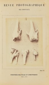 Esostosi multiple simmetriche, femore, tibia da Arthur de Montmeja