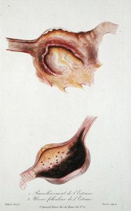Ulcere molli e follicolari dello stomaco, da 