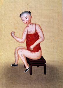 Bambino con vaiolo