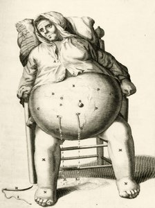 Drenaggio di liquidi da un ascesso, da Exercitationes Practicae circa Medendi Methodum di Frederik Dekkers, 1694 da Dutch School
