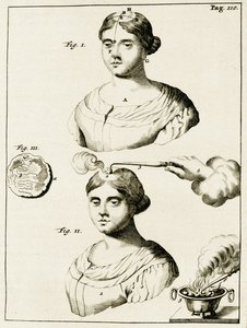 Trattamento di un epilettico, da Exercitationes Practicae circa Medendi Methodum di Frederik Dekkers, 1694 da Dutch School