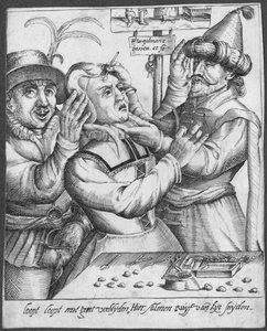 Trapanazione, inciso da H. Weydmans (XVI secolo)