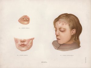 Malattie della Pelle: Herpes da English School