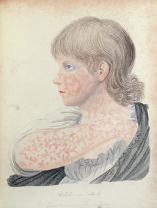 Rosolia, illustrazione per un libro di Robert Willan (1757-1812), 1808 (incisione a colori)