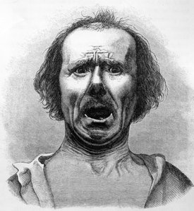 Orrore e Agonia, copiato da una fotografia del Dr. Duchenne, illustrazione da 