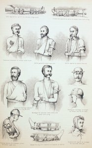 Trattamento temporaneo delle fratture, c.1890