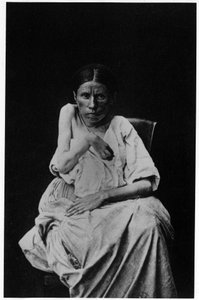 Fotografia di un paziente affetto da epilessia emiplegica, -in "iconografia fotografica della Salpetrière, Bourneville e P. Regnard, Parigi"