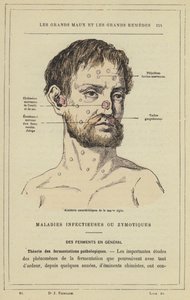 Incidenti caratteristici della morva acuta (litografia a colori) da French School