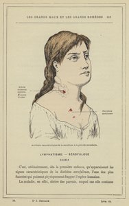 Incidenti caratteristici della scrofulosi nel periodo secondario da French School