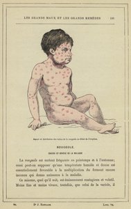 Aspetto e distribuzione delle macchie del morbillo all