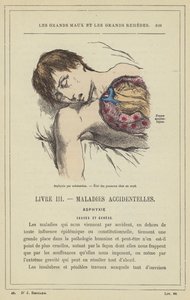 Asfissia per sommersione, stato dei polmoni in un annegato da French School