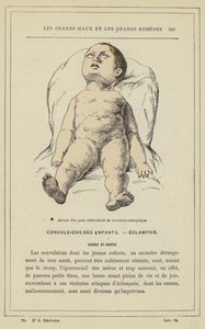 Atteggiamento di un bambino colpito da convulsioni eclamptiche da French School